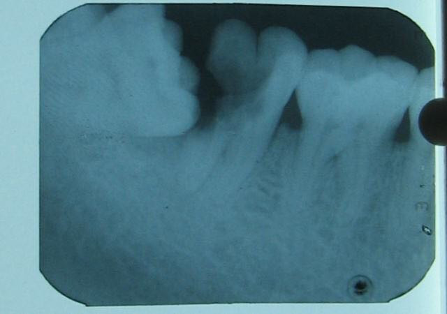 智齿该不该拔,智齿到底该不该拔