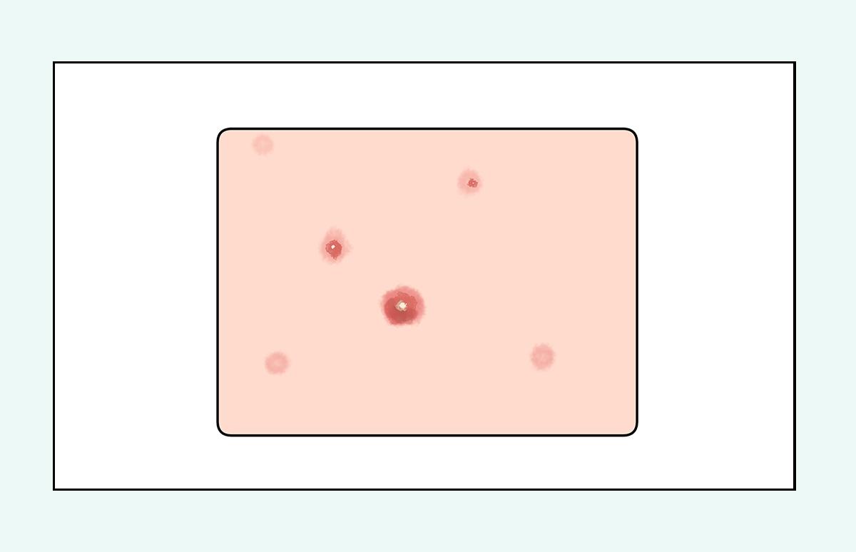 脸上的红疙瘩疼是什么原因,脸上的各种疙瘩