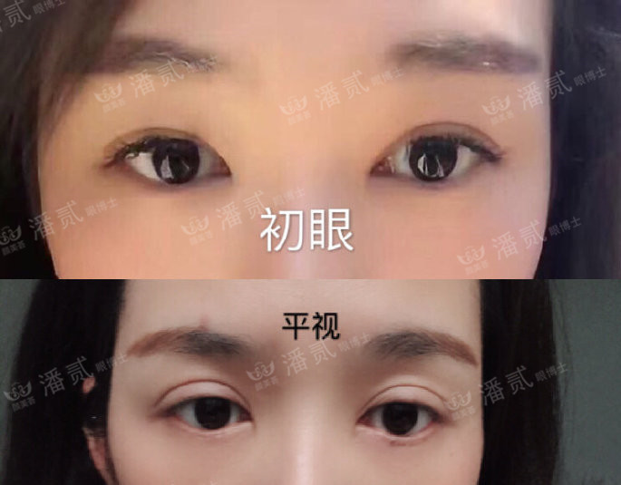 10个工作室做，9个毁，祛眼袋连卧蚕也没了，直接送我到10年后