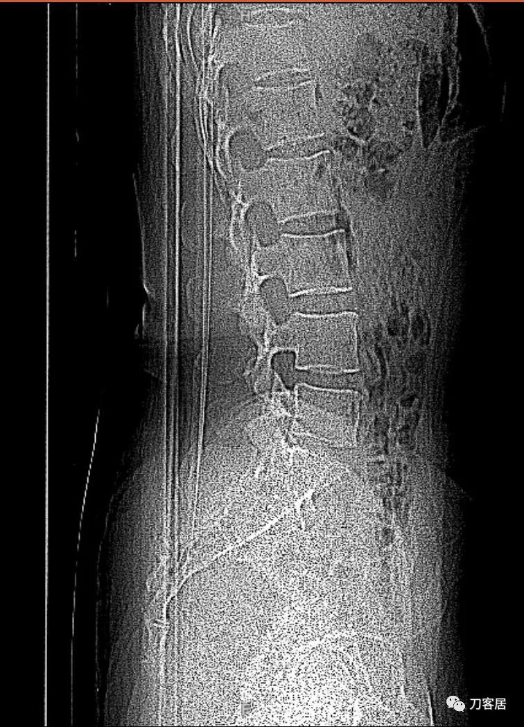 椎间孔镜微创手术13天,椎间孔镜微创手术患者