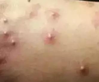 广西一女子被蚂蚁咬伤后不幸身亡,广西姑娘被一只蚂蚁咬到紧急住院