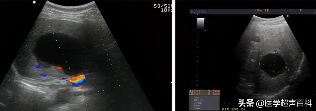 超声肝脏部位检查图,超声肝脏检查视频