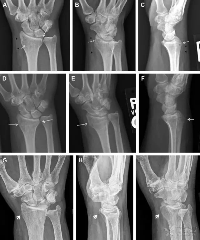 值夜班急救措施,放射科容易漏诊的骨折