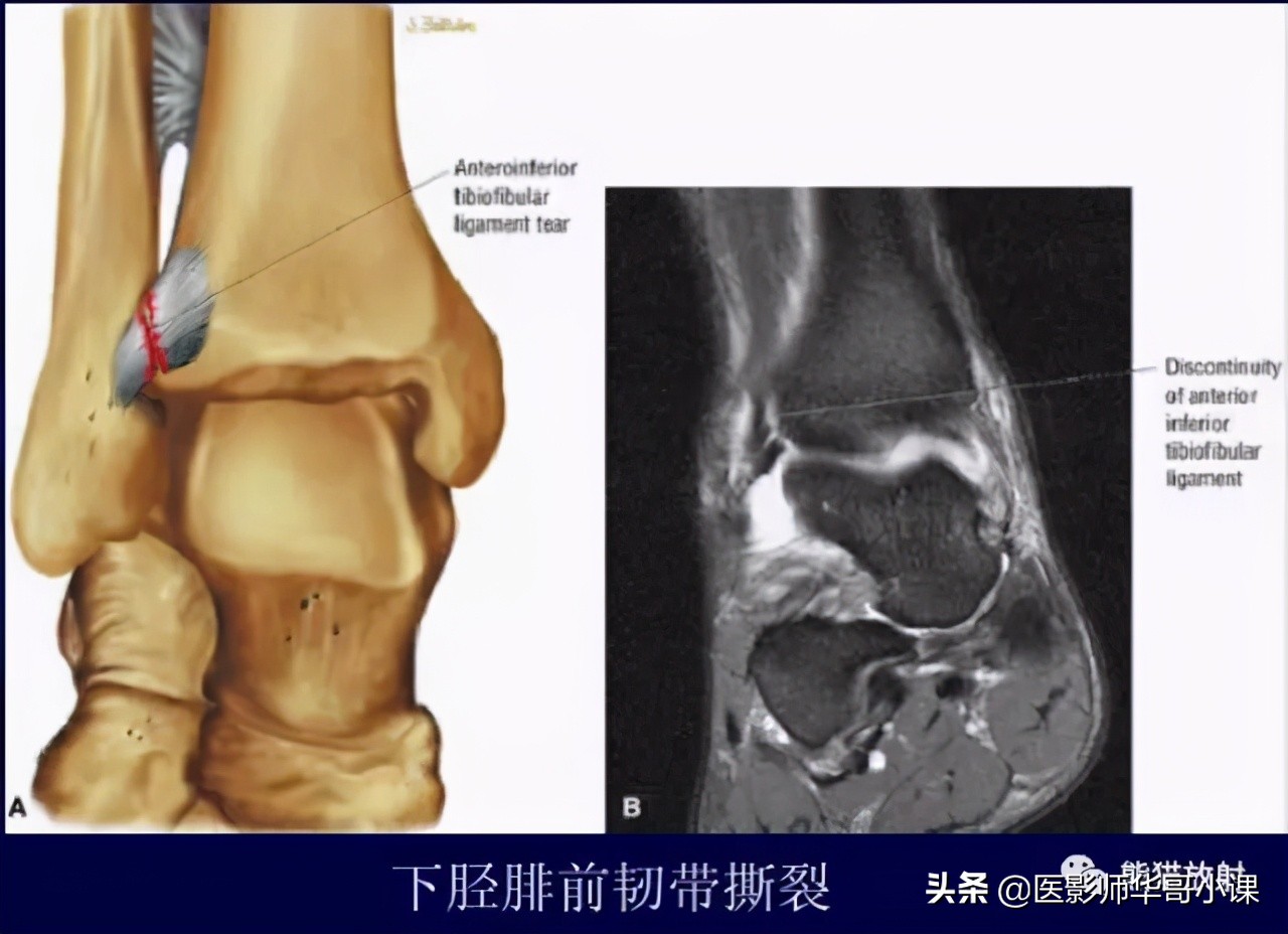 踝关节解剖视频课,解剖学韧带分布图