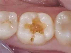 严重的蛀牙怎么修复,轻微的蛀牙修复全过程