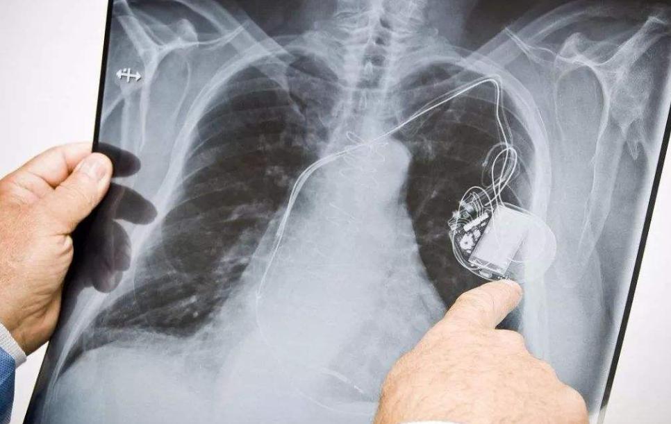 做完ctx光怀孕,怀孕期间做x光胎儿有几率保住么