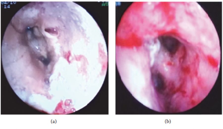 慢阻肺患者合并真菌感染,慢阻肺和真菌定植有关系吗