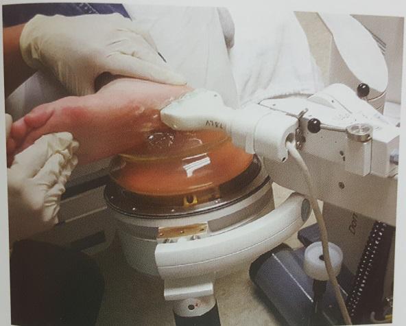 长跑中怎样避免足底筋膜炎,跑步引起的足底筋膜炎的康复训练