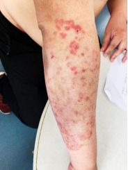 十大皮肤病的偏方,听信偏方的患者