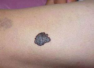 皮肤长了个黑痣褐色会是癌症吗,黑痣附近痒疼是癌症症状表现吗