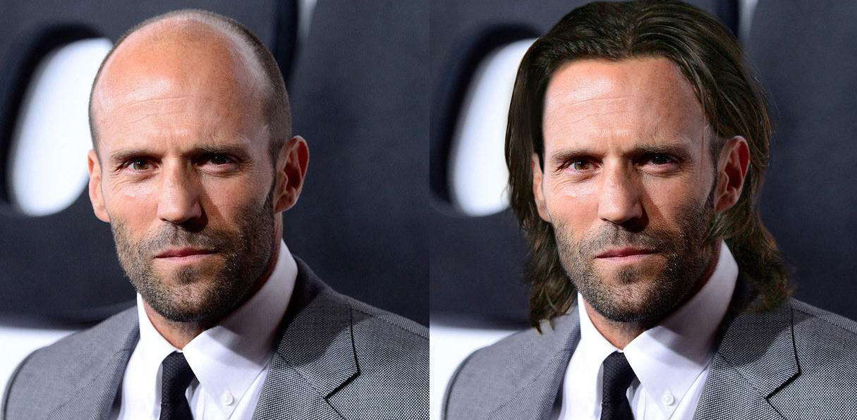 秃如其来怎么办,斑秃后怎么激发黑色毛囊细胞