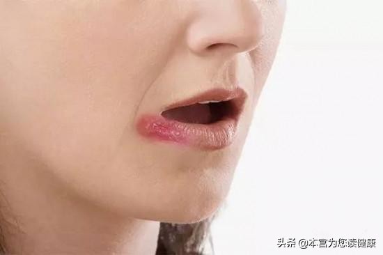 经常烂嘴角是缺什么,经常烂嘴和嘴角发白是缺少什么