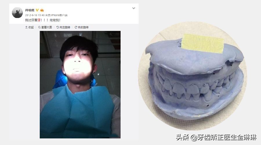 全明星都在做的烤瓷牙真的好吗,为什么明星全瓷牙要几百万