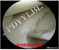 半月板修复视频教程,半月板术后修复