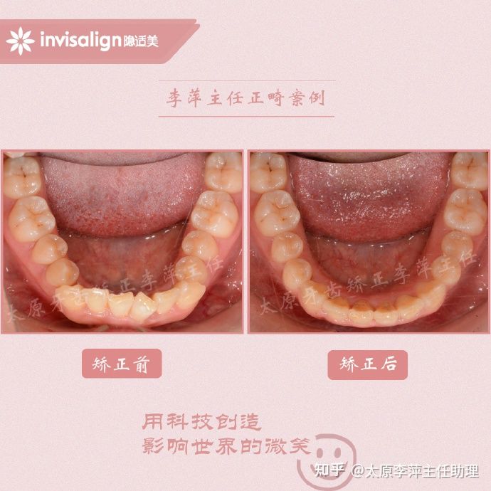 太原矫正牙齿需要做正颌吗,太原牙齿二次矫正