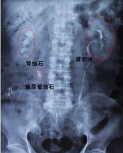 肾结石掉到输尿管是属于尿结石吗,膀胱结石尿路结石和肾结石怎么查