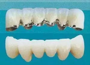 全瓷牙和烤瓷牙到底哪个好,烤瓷牙和全瓷牙优缺点及价格