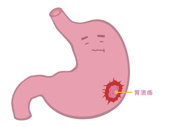吃阿司匹林伤胃了有解药吗,吃阿司匹林对胃伤害怎么办