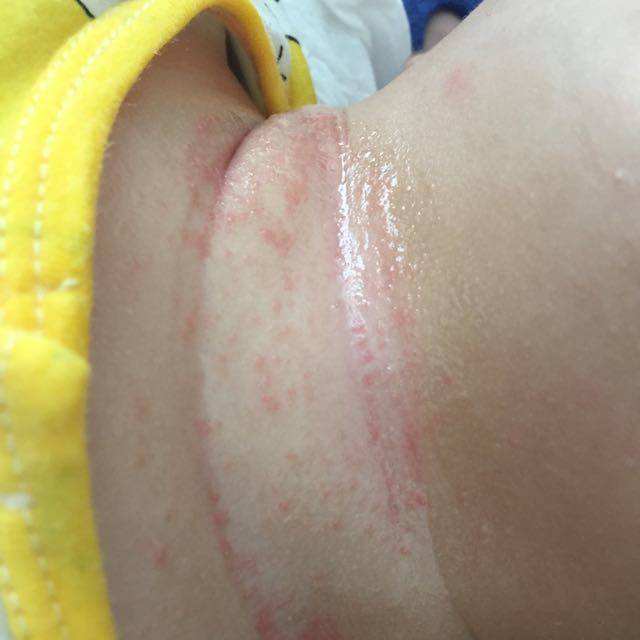 宝宝淹脖子是什么原因引起的,宝宝容易淹脖子怎么办