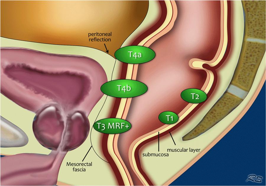 直肠癌“保肛”,你必须知道的知识