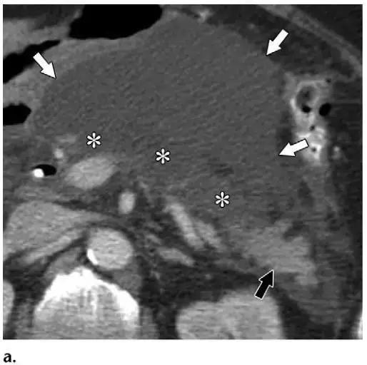 简述急性胰腺炎影像学表现,有关急性胰腺炎疼痛的图片