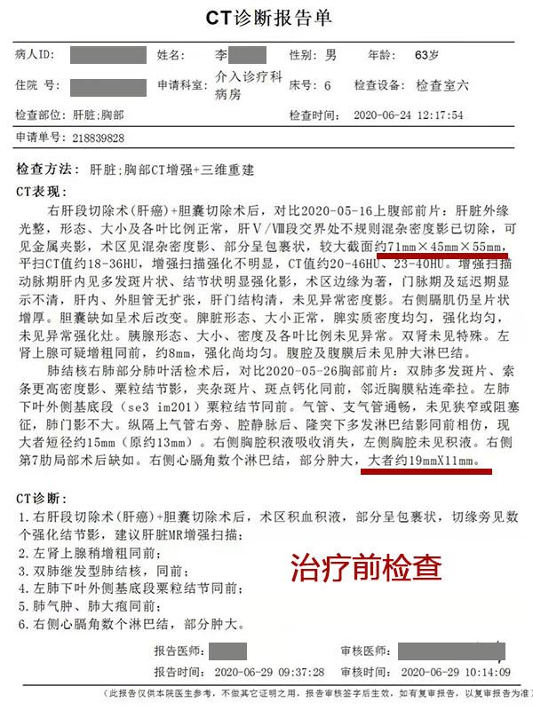 肝癌复发切除后治愈,肝癌复发骨转移