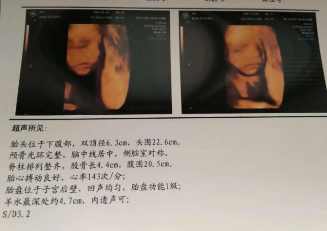 四维彩超之前能吃东西吗,做四维彩超之前用憋尿吗