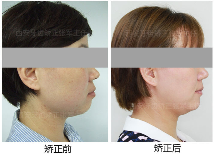 西安透明式牙齿矫正器龅牙,昆明牙齿矫正改变脸型