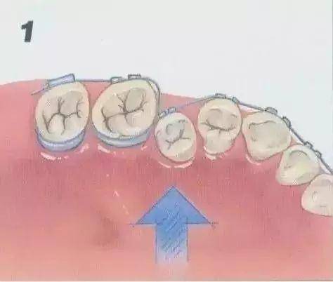 透明牙套和钢牙哪个好,老牙选哪种牙套比较合适价位低