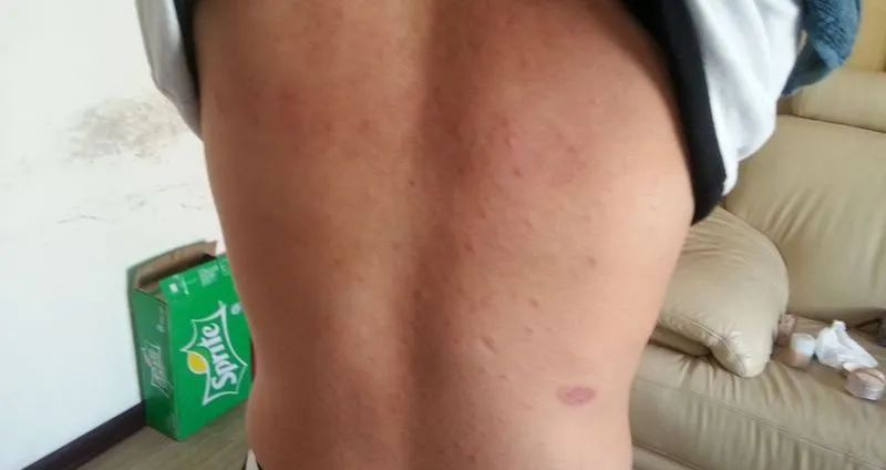 美背长痘,后背长痘的美背方法