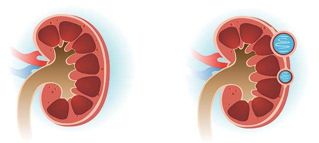 多肾囊肿怎么治疗,肾囊肿会引起高血压吗