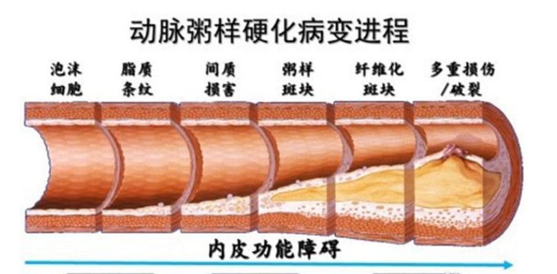 颈部血管有斑块需要怎么处理,颈部血管有斑块可以怎么治疗