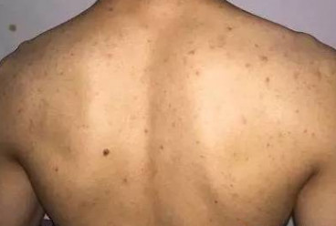 背后长粉刺痘痘是怎么回事,青春期孩子背后长痘是什么原因