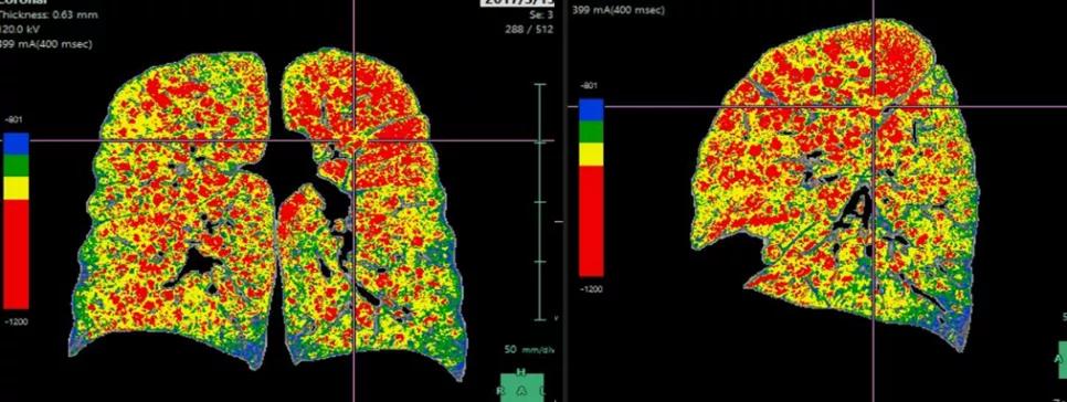 慢阻肺是桶状胸,慢阻肺会出现桶状肺吗