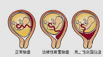 第一次孕检查有问题,孕检可以隐瞒流产记录吗