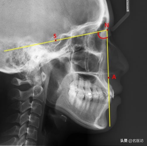矫正科普|美人在骨不在皮，从神秘的牙片看牙齿和侧貌颜值