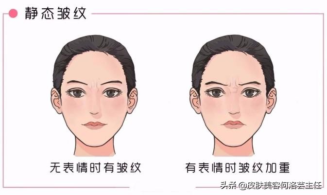 脸上出现皱纹，我老了？5个皱纹产生的原因，别再视而不见
