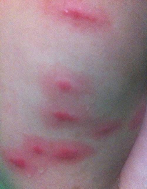 水痘疱疹丘疹一起出现,季节交替带状疱疹进入高发期