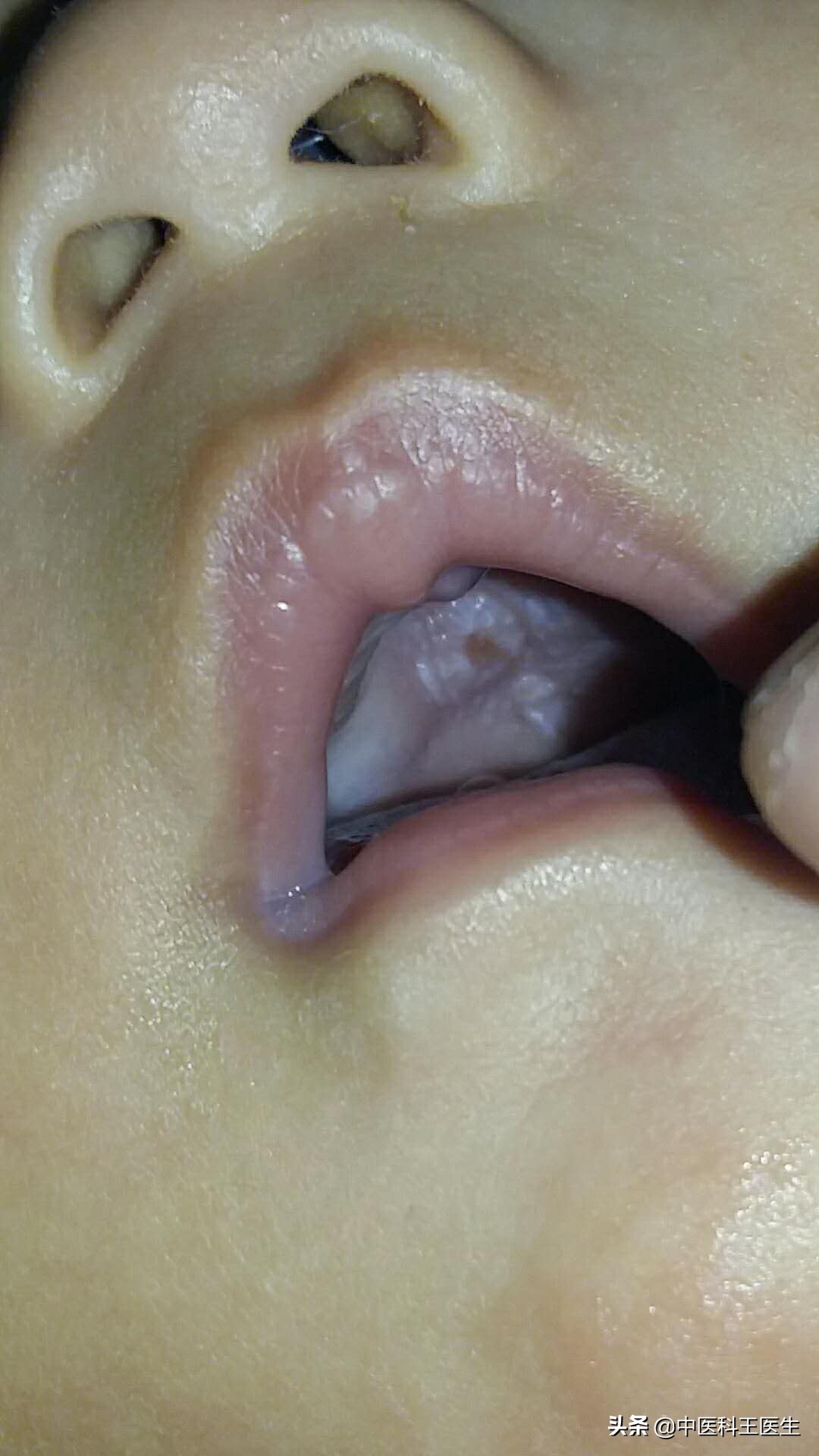 宝宝鹅口疮严重最佳治疗方法,婴儿鹅口疮反反复复怎么才能彻底