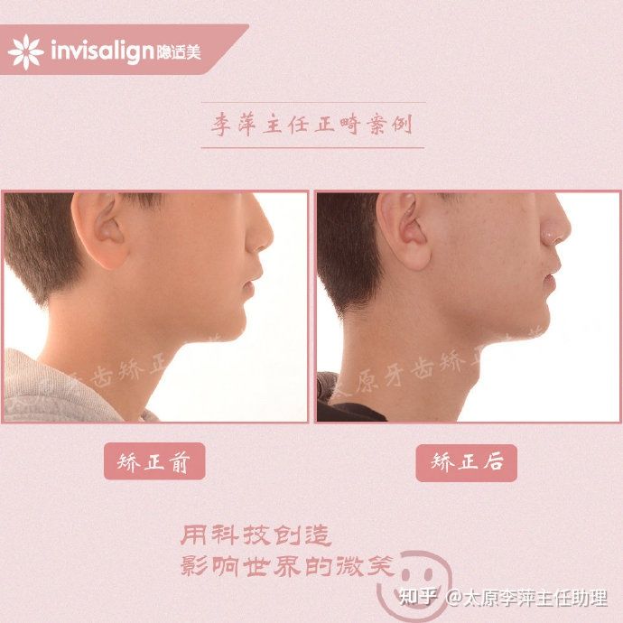 重度拥挤矫正牙齿适合隐形牙套吗,广州成人牙齿矫正推荐隐形牙套