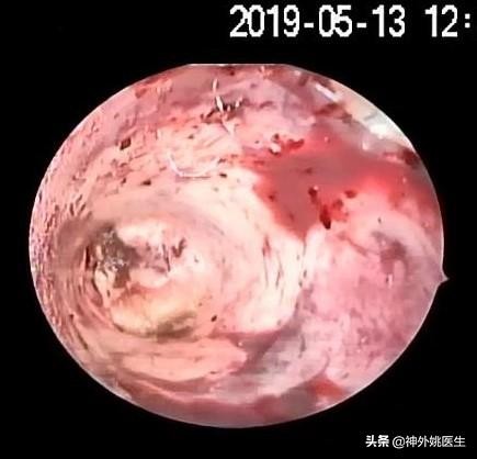 球囊扩张血肿怎么办,经皮穿刺脑血管腔内球囊成形术