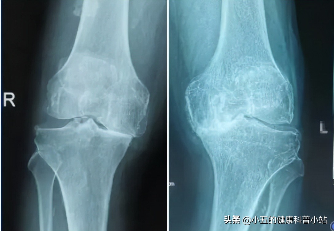 膝关节咔咔作响怎么回事,膝盖痛髌骨软化症怎么治疗