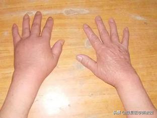 黄煌中风偏瘫后遗症,黄老师偏瘫