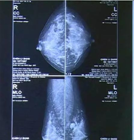 乳房按摩是骗局吗,乳房按摩风险