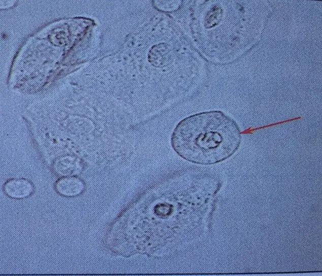 上皮细胞3+什么意思,上皮细胞阳性