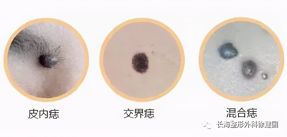 小痣好切还是大痣好切,有个痣是点痣好还是直接切掉好