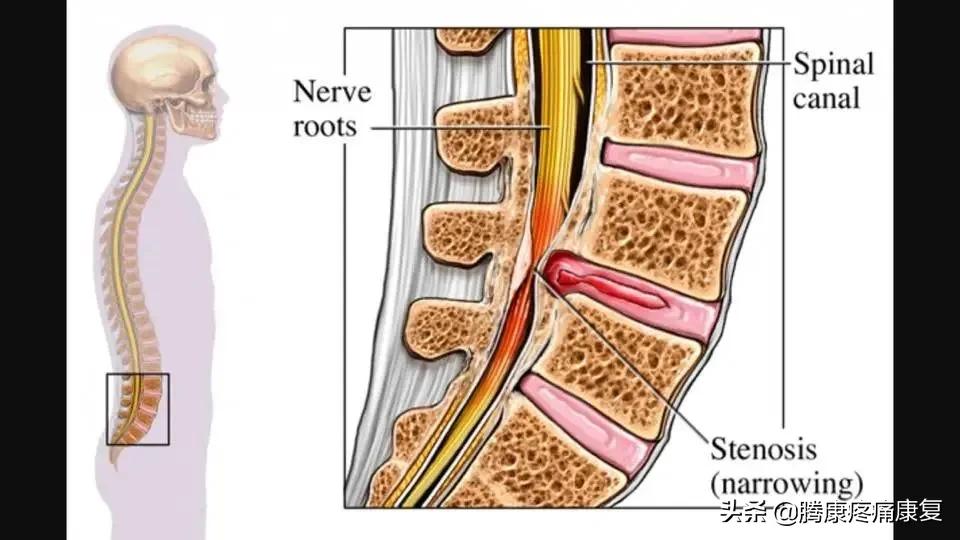 腰椎间盘突出的12组锻炼动作,腰椎间盘4-5节突出压迫神经怎么办