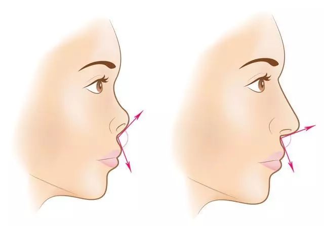 6种整容级鼻型修容法,蒜头鼻加朝天鼻修容