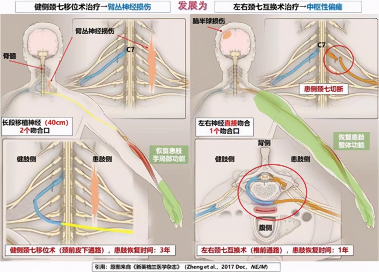 脑血栓偏瘫最好的治疗方法,如何预防脑血栓及中风发生