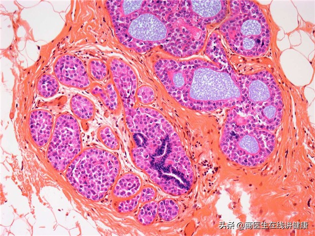 浸润癌是最严重的癌吗,浸润癌恶性